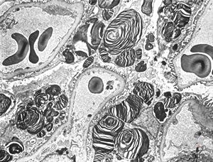 M,27y. | sea-blue histiocyte syndrome